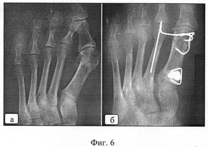 Синостозирующее устройство для реконструкции переднего отдела стопы (патент 2402294)