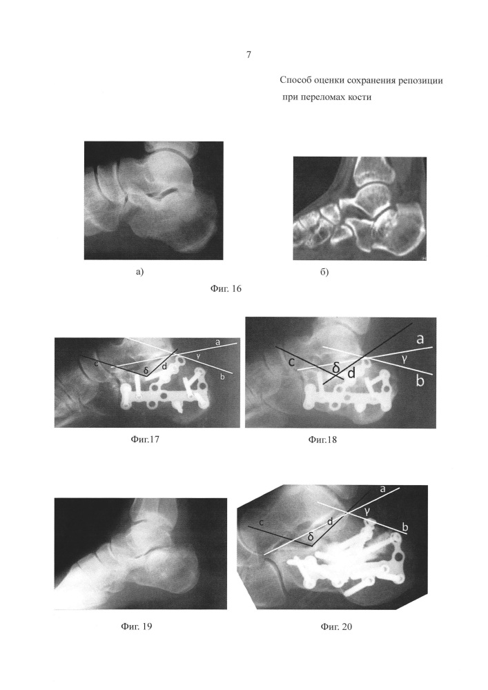 Способ оценки сохранения репозиции переломов костей (патент 2626375)