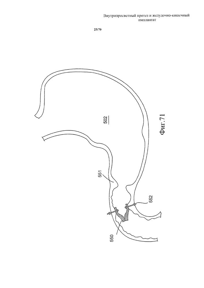 Внутрипросветный протез и желудочно-кишечный имплантат (патент 2626885)