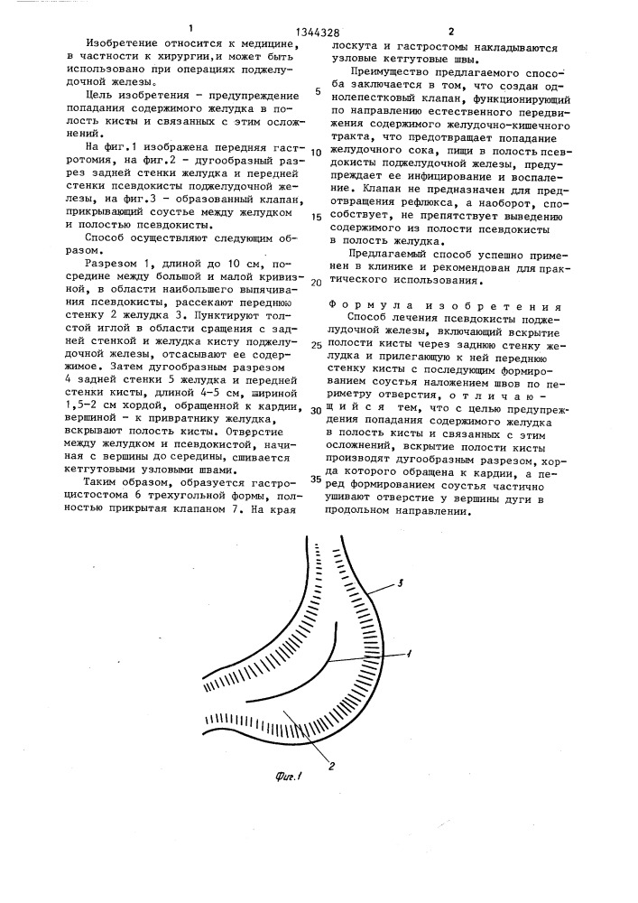 Способ лечения псевдокисты поджелудочной железы (патент 1344328)