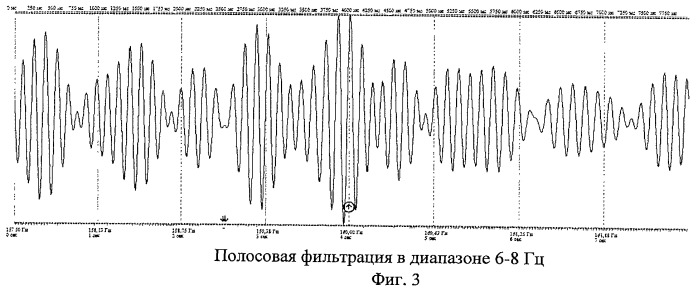 Способ определения синхронизации и десинхронизации биоэлектрической активности мозга (патент 2454172)