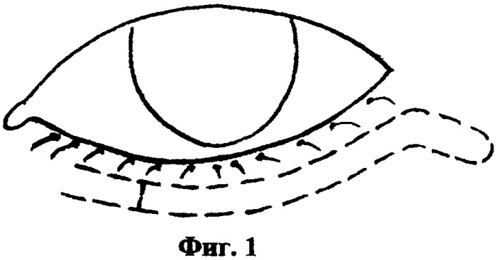 Способ хирургического лечения заворота нижнего века (патент 2342917)