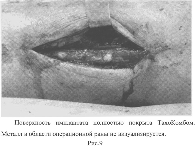 Способ лечения переломов при накостном остеосинтезе (патент 2526472)