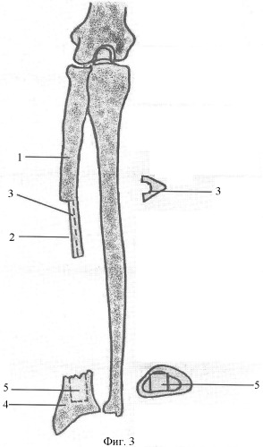 Способ хирургического лечения сегментарных дефектов диафизов костей предплечья (патент 2358677)