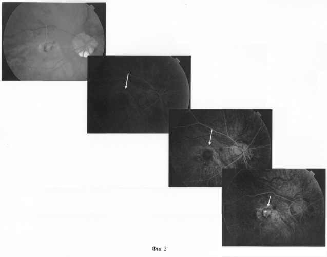 Способ лечения субретинальной неоваскулярной мембраны (патент 2290973)