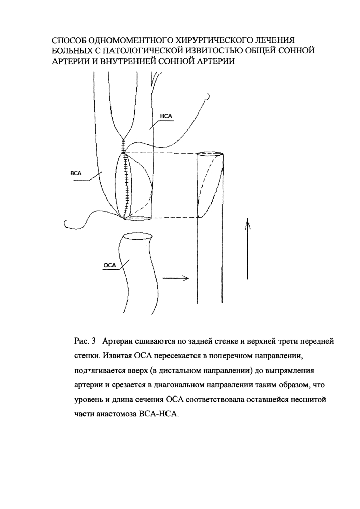 Способ одномоментного хирургического лечения больных с патологической извитостью общей сонной артерии и внутренней сонной артерии (патент 2618209)