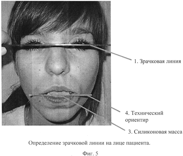 Способ конструирования протетической плоскости (патент 2573555)