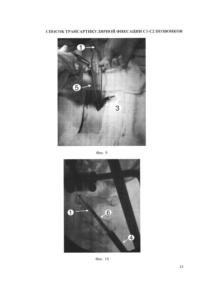 Способ выполнения трансартикулярной фиксации с1-с2 позвонков (патент 2662203)