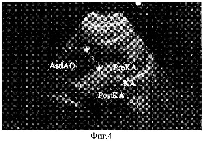 Способ ультразвуковой диагностики коарктации аорты (патент 2244512)