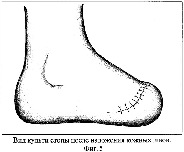 Способ формирования культи стопы (патент 2308244)