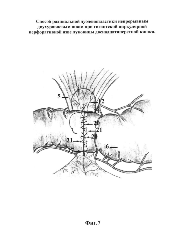 Способ радикальной дуоденопластики непрерывным двухуровневым швом при гигантской циркулярной перфоративной язве луковицы двенадцатиперстной кишки (патент 2664176)