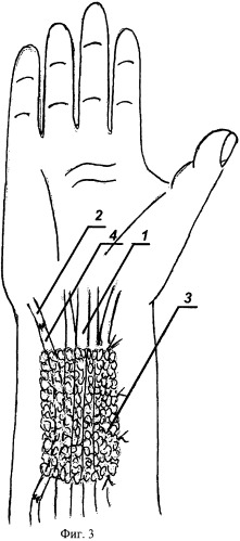 Способ хирургической профилактики образования рубцового блока сухожилий предплечья (патент 2445030)