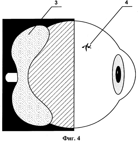 Способ хирургического лечения глаукомы с нормализованным внутриглазным давлением (патент 2267310)