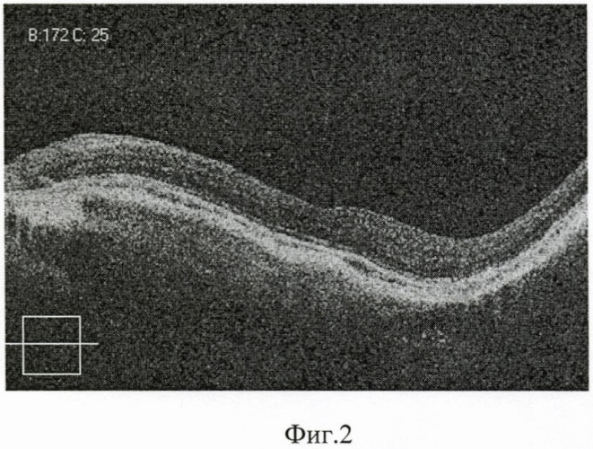 Способ ранней доклинической диагностики прогрессирования эпиретинальной мембраны у пациентов с высокой миопией (патент 2407444)