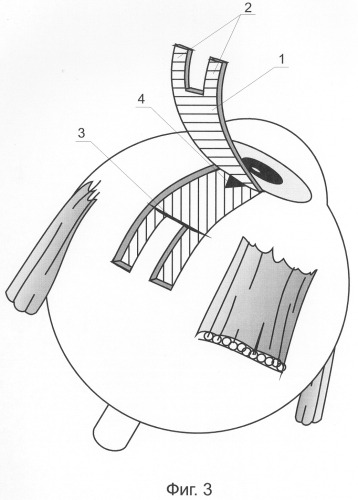 Способ хирургического лечения глаукомы (патент 2290149)