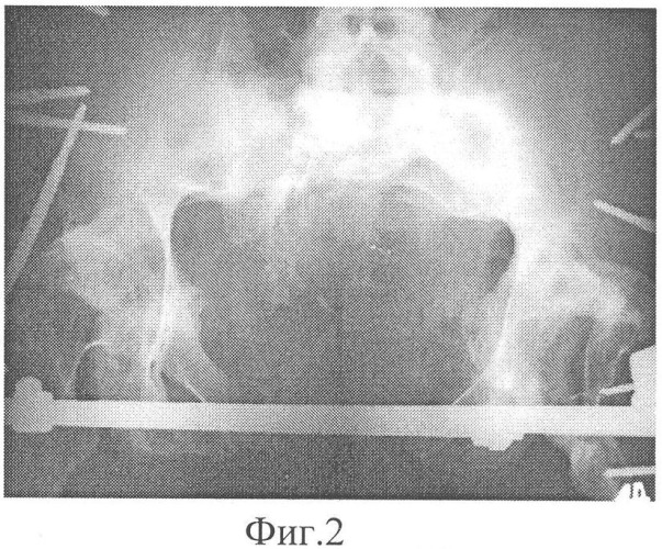 Способ лечения больных с неправильно сросшимися множественными переломами костей таза (патент 2328998)