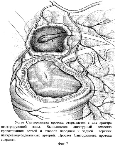 Способ хирургического лечения низких осложненных пенетрацией и кровотечением гигантских дуоденальных язв (патент 2259169)