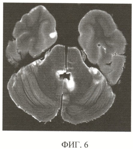 Способ комплексной посмертной патоморфологической диагностики заболеваний головного мозга (патент 2355311)