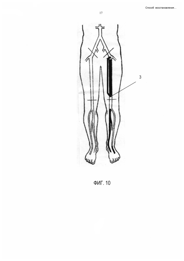 Способ восстановления магистрального артериального кровотока нижних конечностей (патент 2601698)