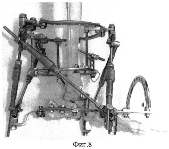 Способ остеосинтеза аппаратом орто-сув для устранения вывихов в голеностопном суставе (патент 2547798)
