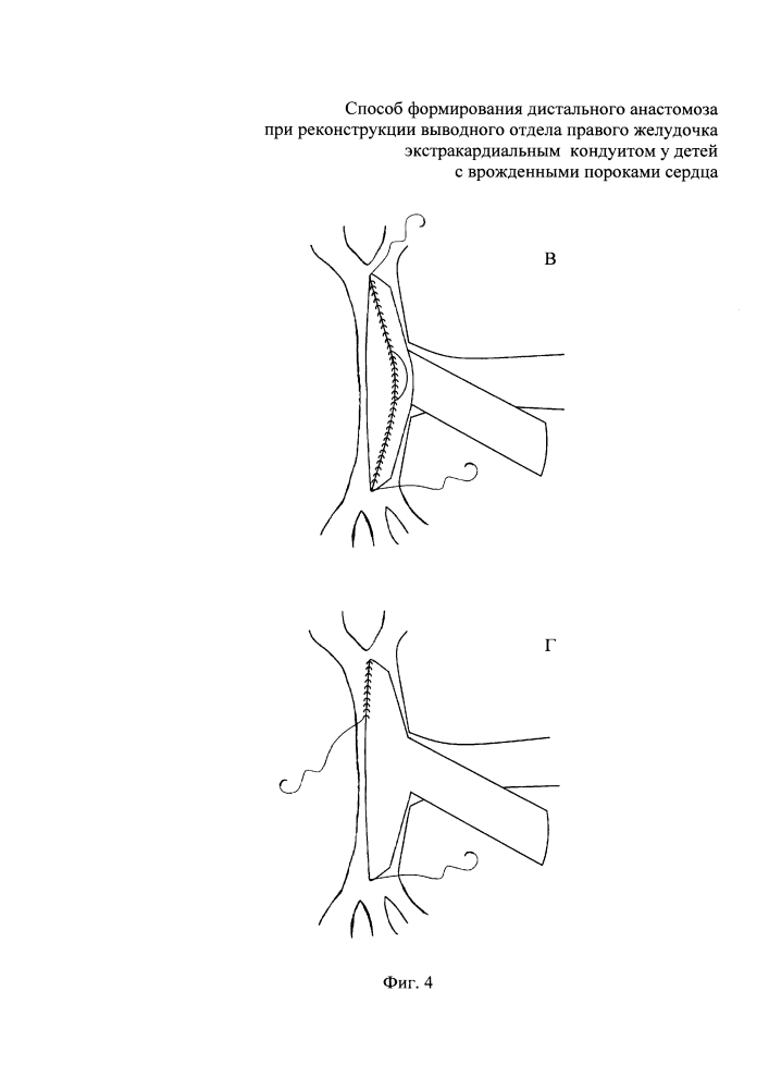 Способ формирования дистального анастомоза при реконструкции выводного отдела правого желудочка экстракардиальным кондуитом у детей с врожденными пороками сердца (патент 2644921)