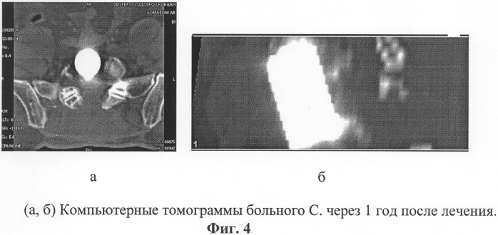 Способ хирургического лечения опухолей позвоночника (патент 2279860)