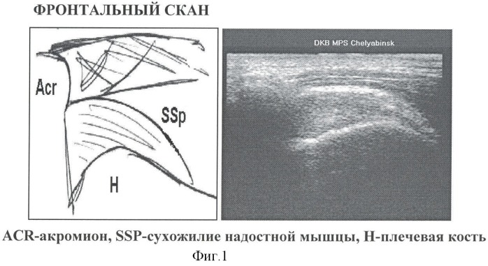 Способ ультразвуковой диагностики типа положения акромиального отростка лопатки относительно головки плечевой кости (патент 2367346)