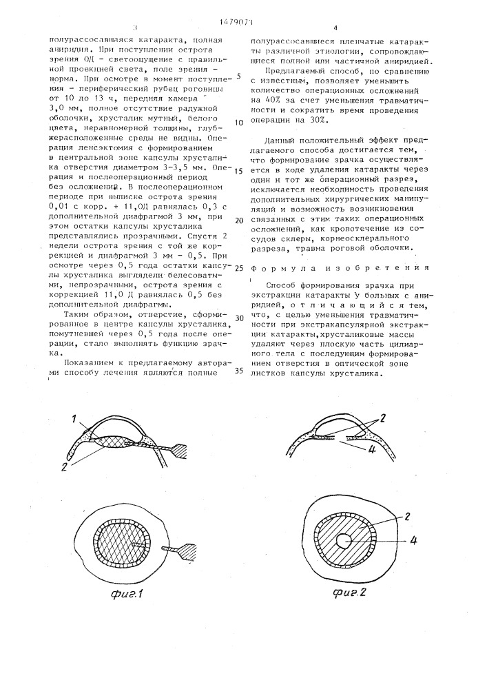 Способ формирования зрачка при экстракции катаракты у больных с аниридией (патент 1479073)