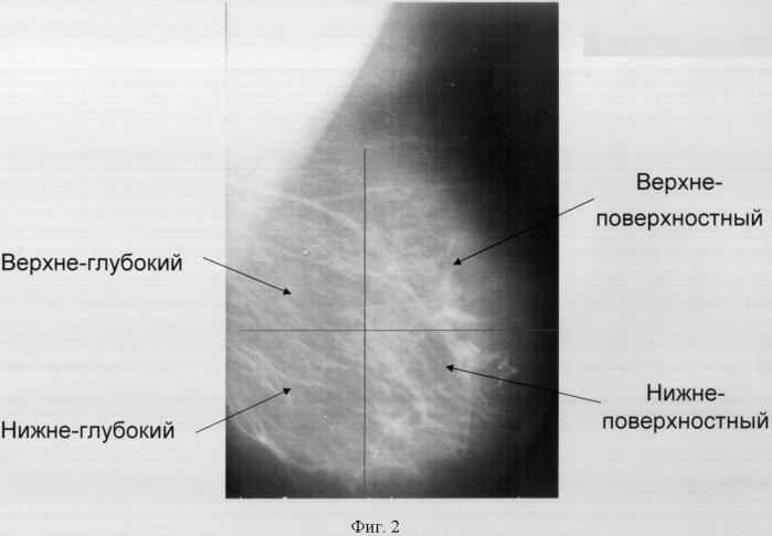 Способ оценки доли жировой ткани в молочной железе (патент 2325852)