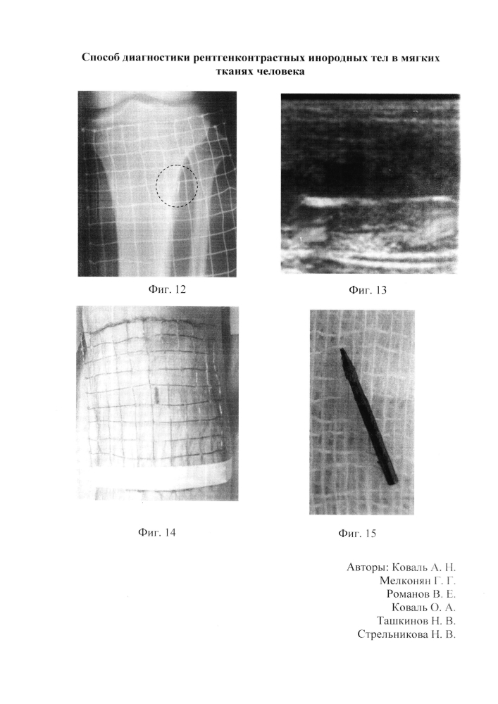 Способ диагностики рентгенконтрастных инородных тел в мягких тканях человека (патент 2605148)