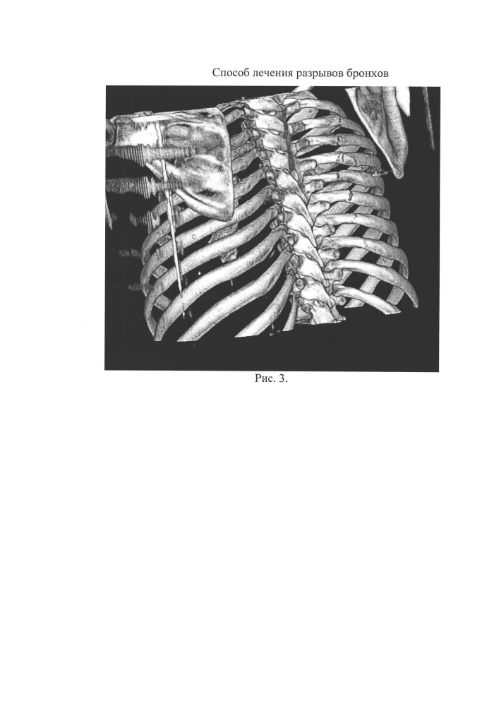 Способ лечения разрывов крупных бронхов (патент 2651691)
