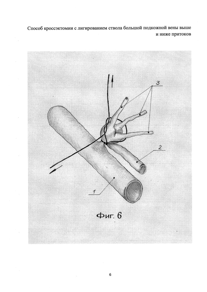 Способ кроссэктомии с лигированием ствола большой подкожной вены выше и ниже притоков (патент 2607919)