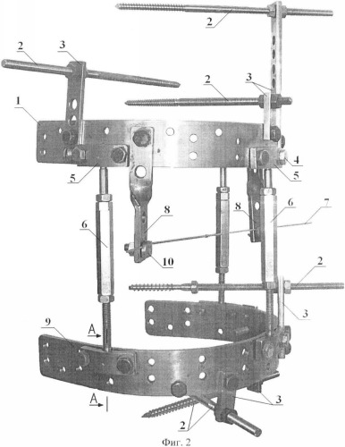 Шарнирный аппарат для репозиции и фиксации переломов длинных трубчатых костей (патент 2363414)