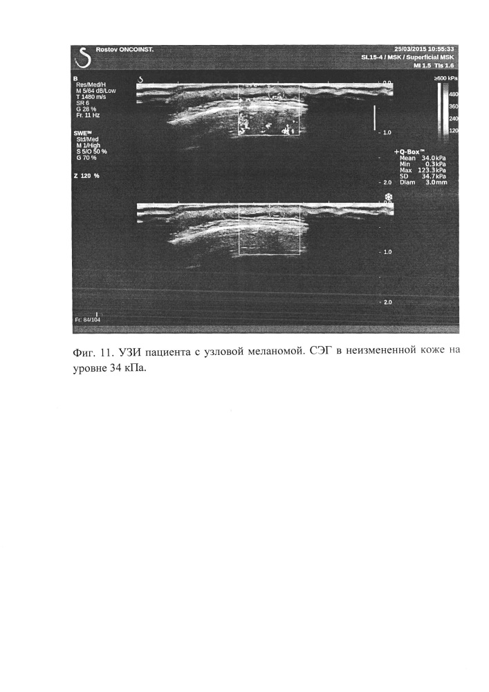 Способ дифференциальной диагностики меланоцитарных образований кожи (патент 2635772)