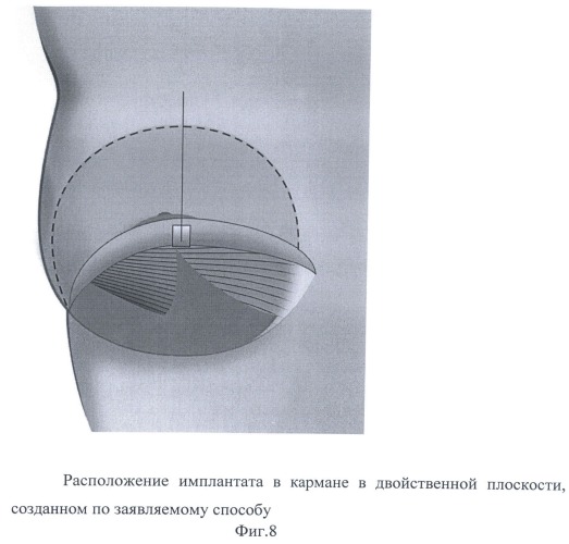 Способ формирования кармана для имплантата в двойственной плоскости при аугментационной маммопластике (патент 2501528)