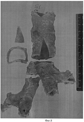 Способ приведения в соответствие периметров сечения трахеи и левого главного бронха при наложении трахеобронхиального анастомоза (патент 2467701)