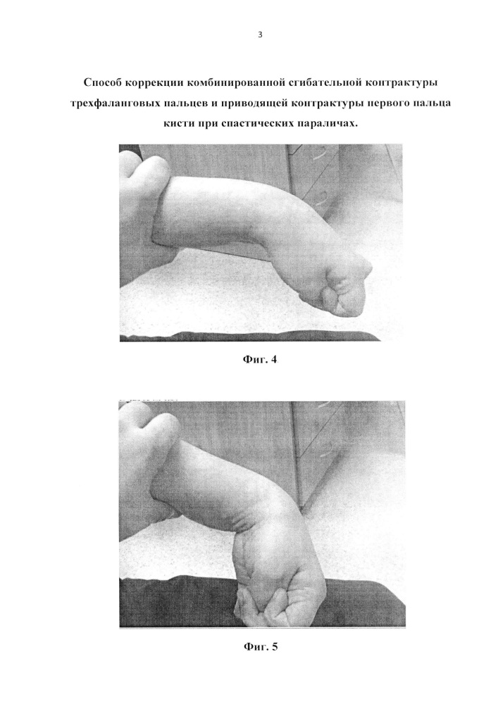 Способ коррекции комбинированной сгибательной контрактуры трехфаланговых пальцев и приводящей контрактуры первого пальца кисти при спастических параличах (патент 2627291)