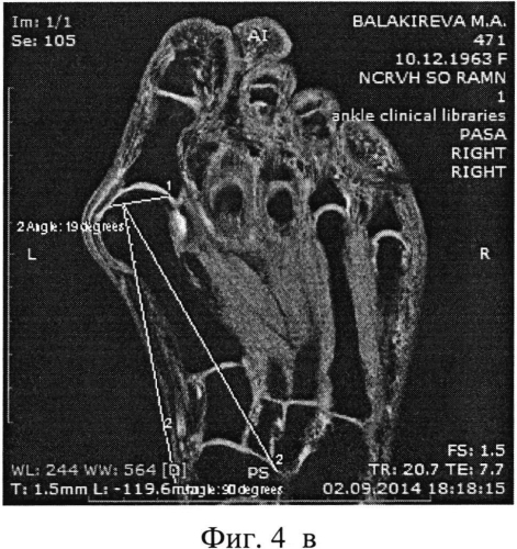 Способ определения наклона суставной поверхности головки первой плюсневой кости стопы (патент 2567825)