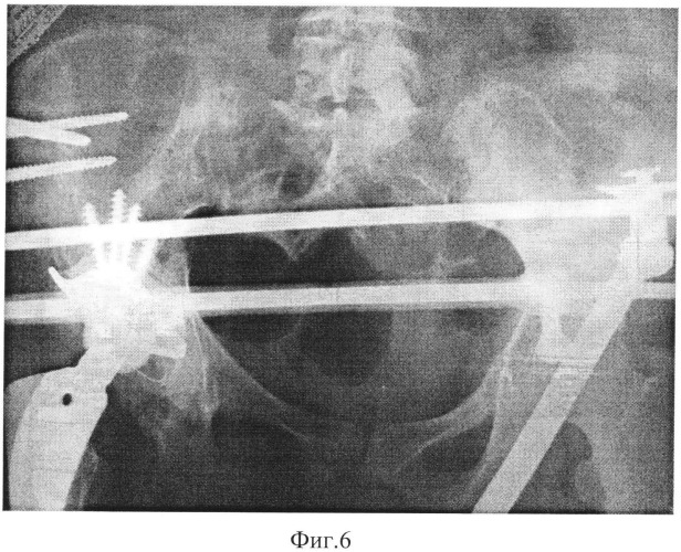 Способ артродезирования крестцово-подвздошного сочленения (патент 2543854)