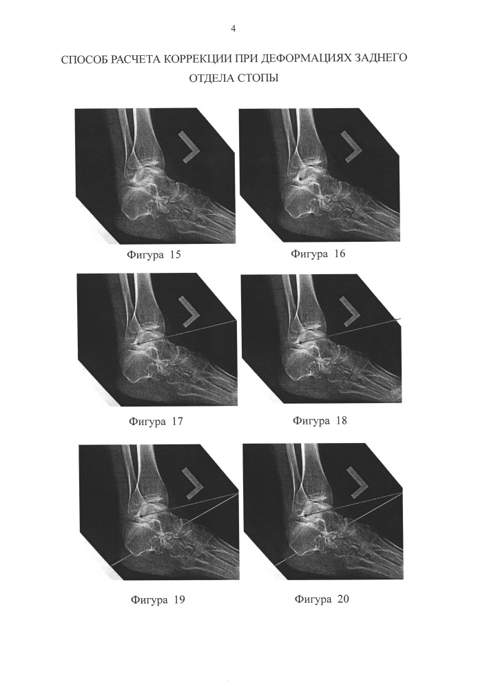 Способ расчета коррекции при деформациях заднего отдела стопы (патент 2634043)