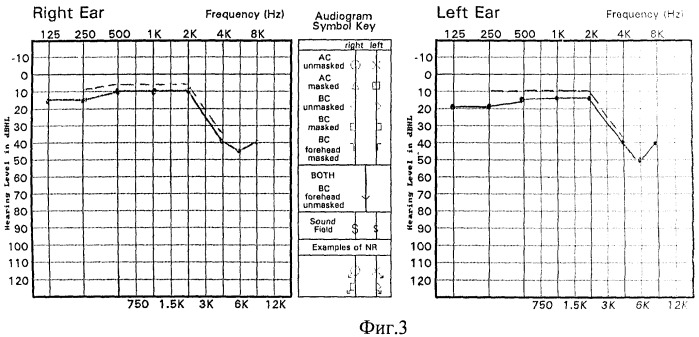 Способ диагностики профессиональной сенсоневральной тугоухости (патент 2412648)