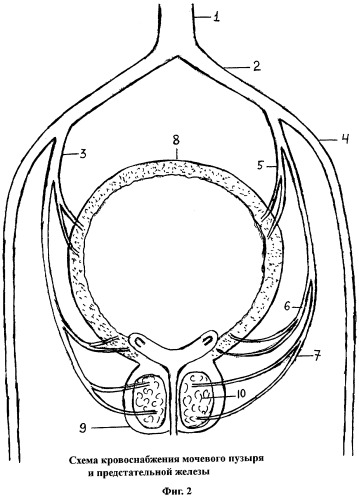 Способ лечения доброкачественной гиперплазии предстательной железы (патент 2275896)
