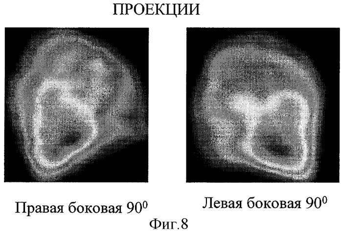 Способ дифференциальной диагностики острых инфекционных заболеваний легких и тромбоэмболий мелких ветвей легочной артерии (патент 2310385)