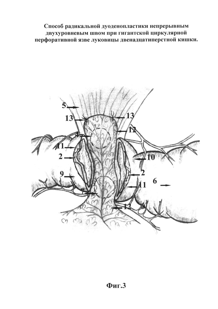 Способ радикальной дуоденопластики непрерывным двухуровневым швом при гигантской циркулярной перфоративной язве луковицы двенадцатиперстной кишки (патент 2664176)