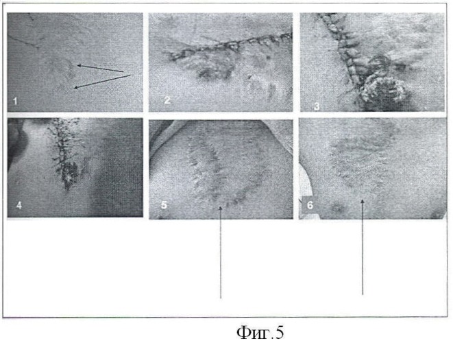 Метод лечения детей с рубцами кожи (патент 2452407)