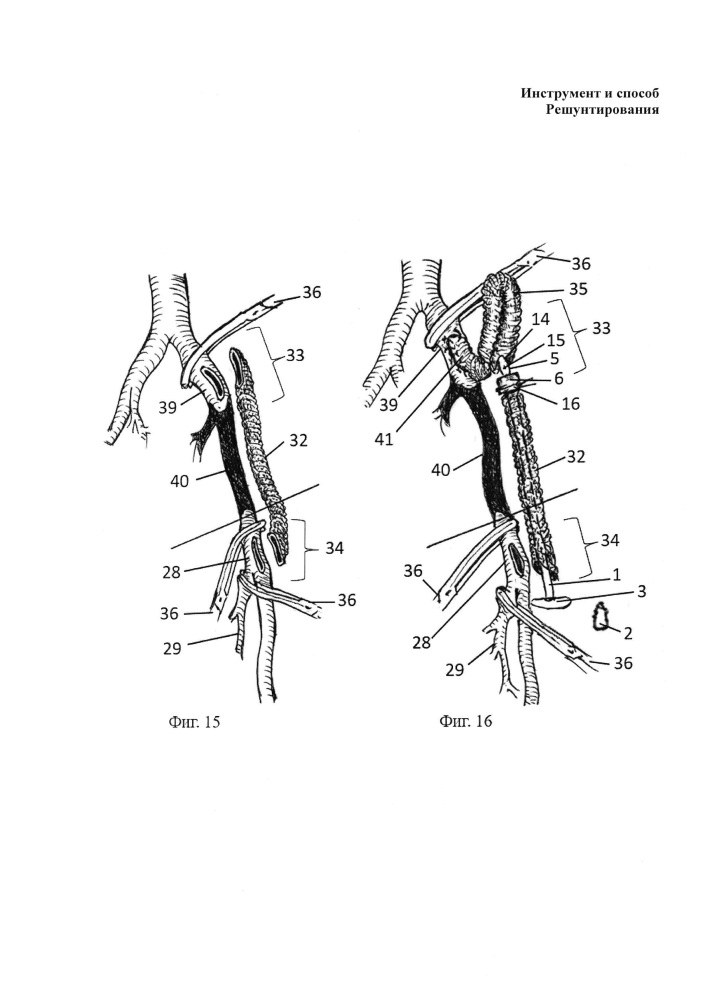 Универсальный инструмент для хирургического полного решунтирования артериального русла и способ хирургического полного решунтирования артериального русла с применением универсального инструмента (патент 2625593)