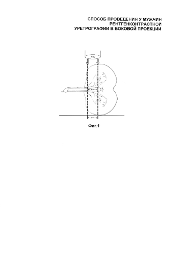 Способ проведения рентгенконтрастной уретрографии в боковой проекции (патент 2592683)