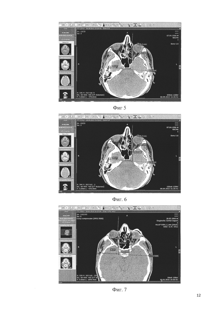 Способ пошаговой компьютерной экзофтальмометрии (патент 2622978)