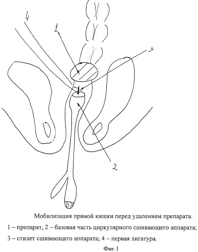 Способ формирования аппаратного колоректального анастомоза (патент 2476160)