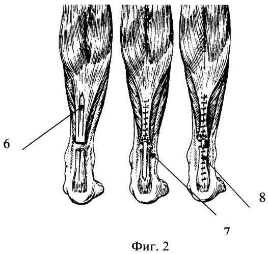Способ пластики разорванных сухожилий (патент 2372862)